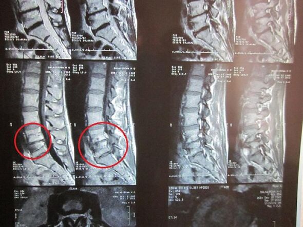 A méhnyak osteokondrózis diagnosztizálása