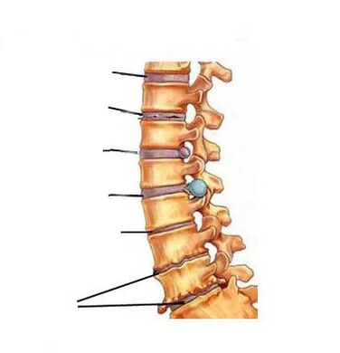 Hogyan alakul ki az osteochondrosis