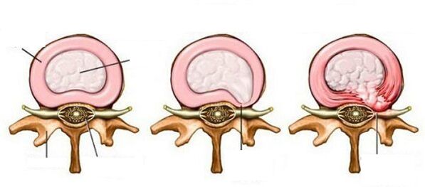 csigolyák közötti sérv méhnyak osteochondrosis