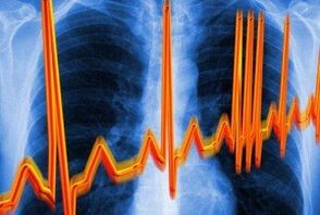 szívritmuszia osteochondrosishoz